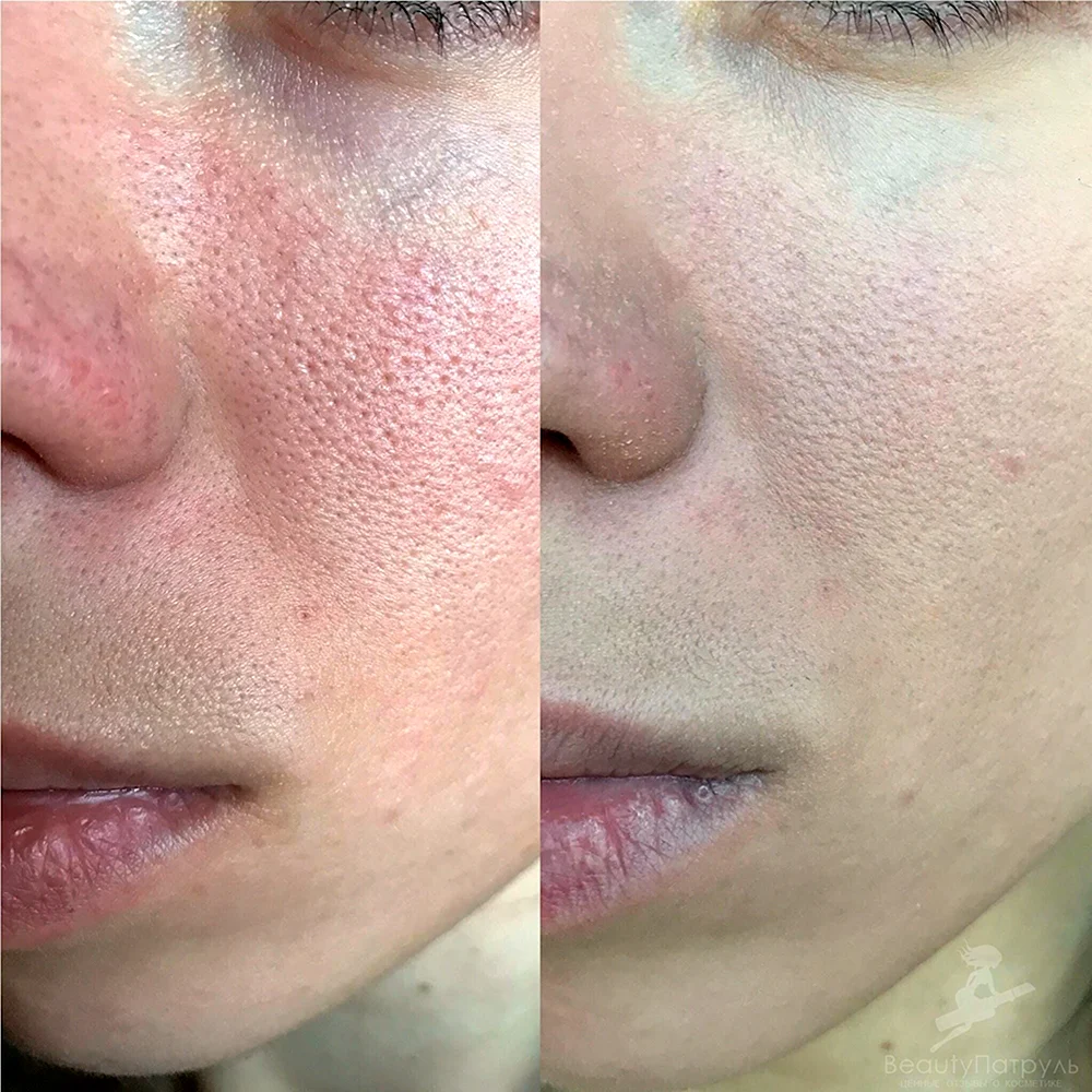 BB Glow before and after