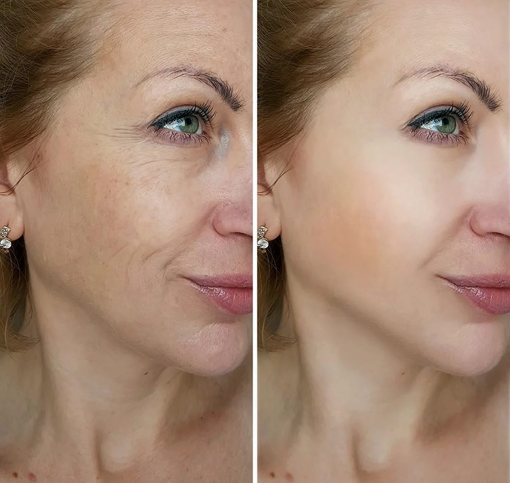 Face Lifting treatment before after