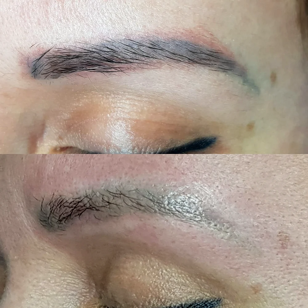 Laser Eyebrow removal