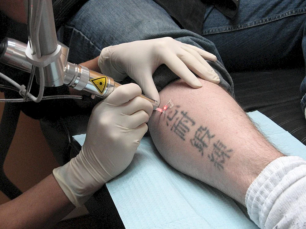 Лазерное удаление тату