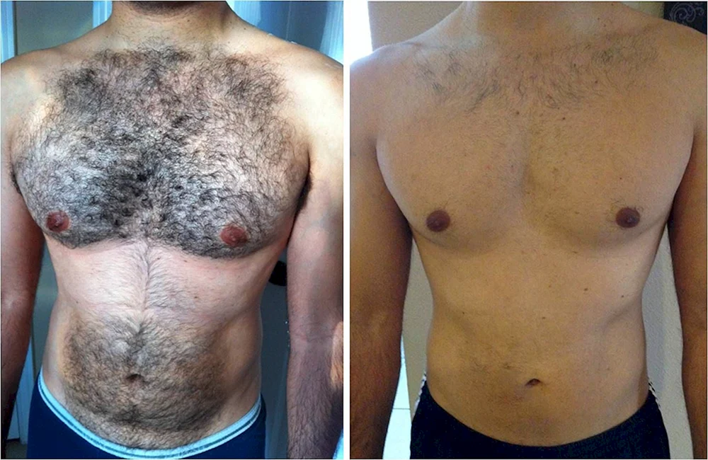 Man Chest hair removal