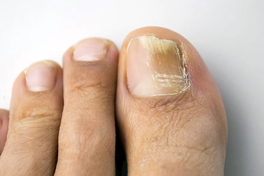Негрибковые заболевания ногтей