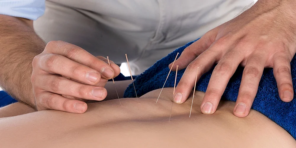 Physio Acupuncture