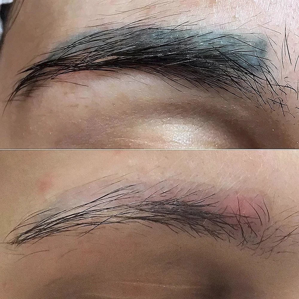 Removing Eyebrow Tattoo with Laser