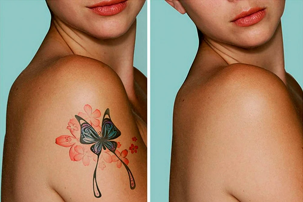 Выведение цветных татуировок лазером